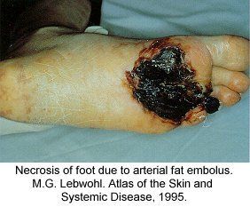 festered_limbs_feet_fingers029.jpg
