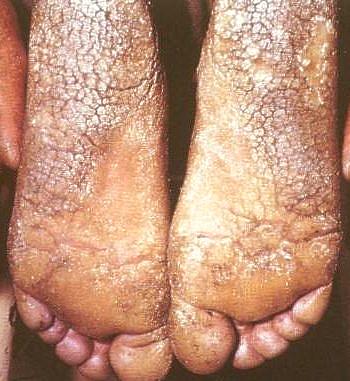 festered_limbs_feet_fingers013.jpg
