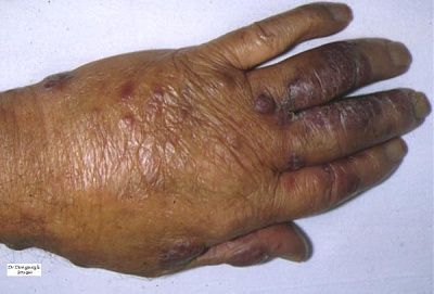 kaposi01.jpg
