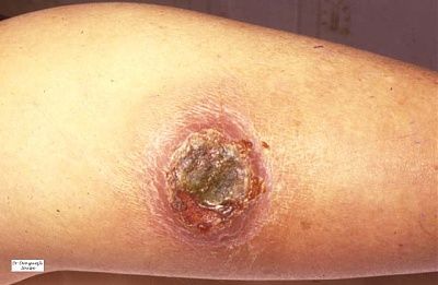 ecthyma.jpg
