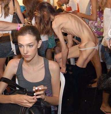 Anorexia Nervosa: Severe Anorexia Collection of Women and Men - very skinny fashion mode preview