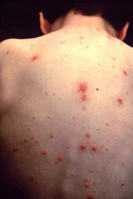 403px-varicella.jpg