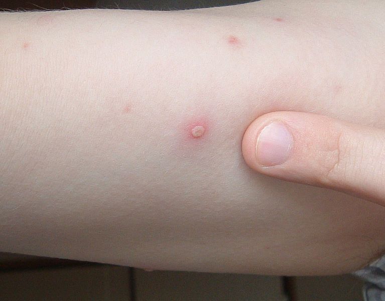 767px-Chickenpox_blister_2006.01.06.jpg