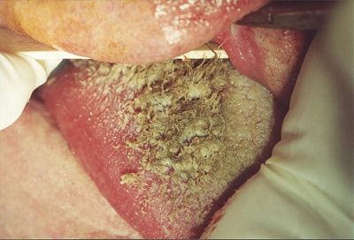 hairy_tongue_small.jpg