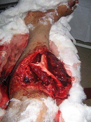 leg-fracture.jpg