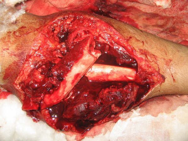 leg fracture 1.jpg