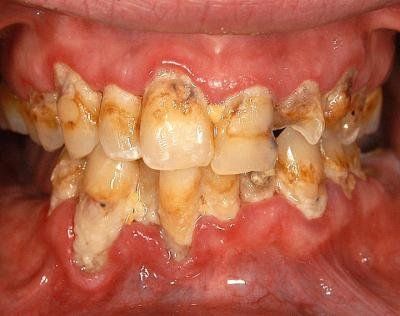 meth-mouth-gallery-1.jpg