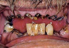 meth-mouth-gallery-2.jpg