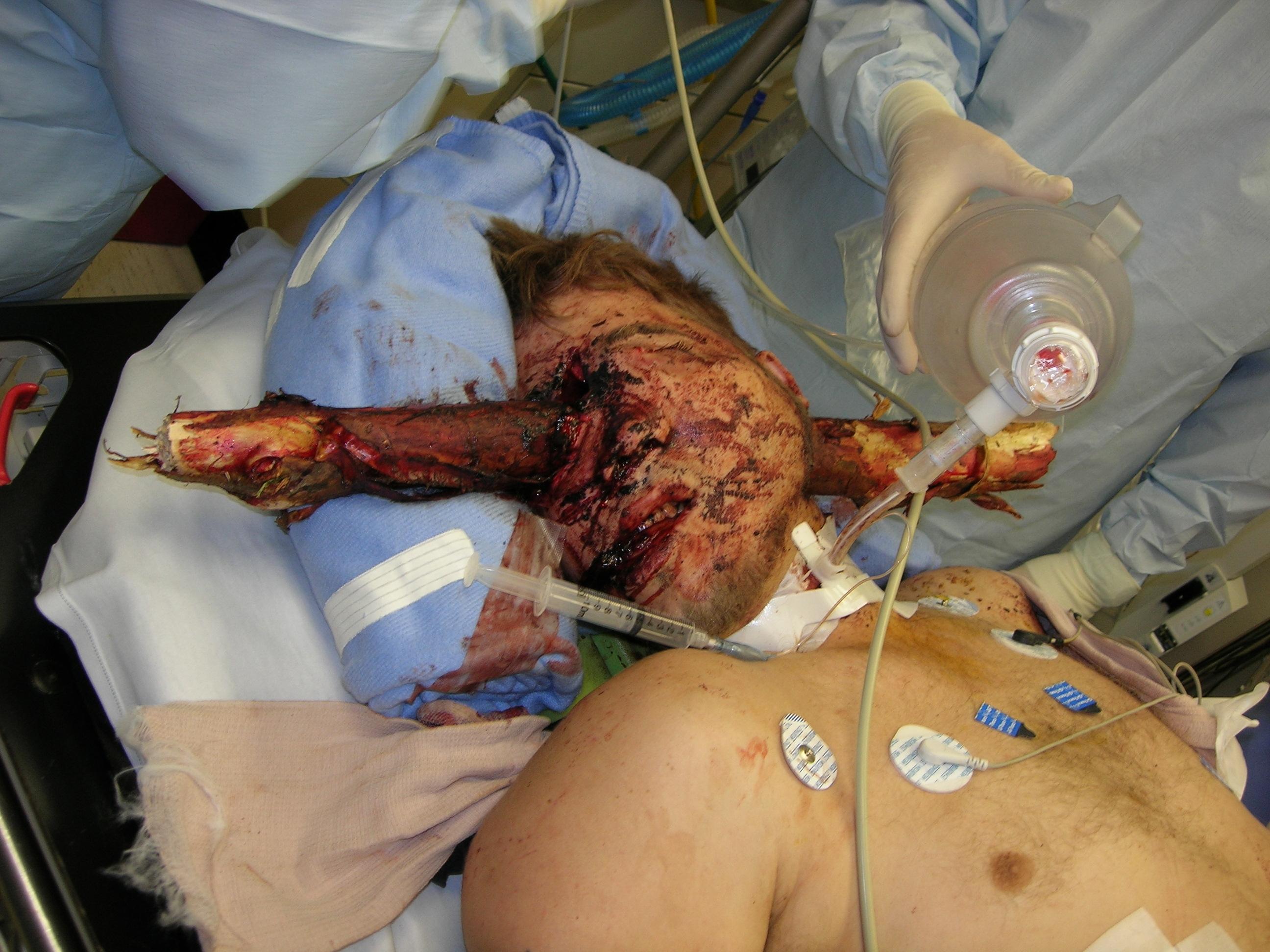Head impalement.jpg