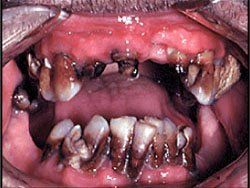 meth-mouth-gallery-5.jpg