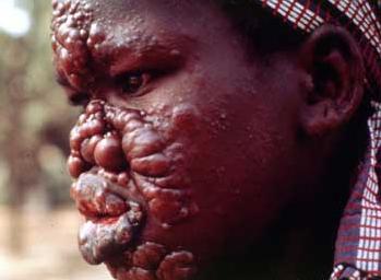 leprosy.jpg