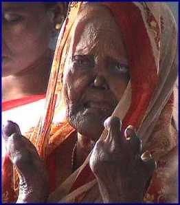 MLS-leprosy%2011.jpg