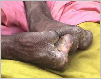 symptoms-of-leprosy-2.jpg