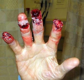 loosing-fingers.jpg