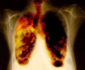 Lung-Cancer.jpg