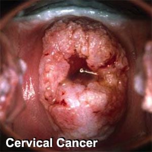 cervicalcancer.jpg