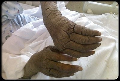 scabies_s16_norwegian_scabies.jpg