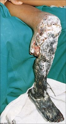 necrosis_snakebite_leg.jpg