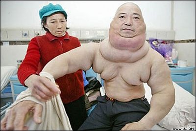 michelin_man_tumor.jpg