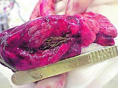 16 Most Bizarre and Horrific Human Growths of All Time 12.jpg