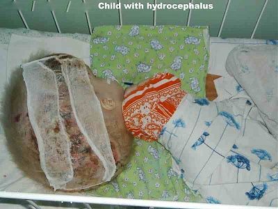 charonboat_dot_com_hydrocephalus_1.jpg
