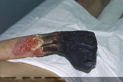 charonboat_dot_com_gangrene_hand.jpg