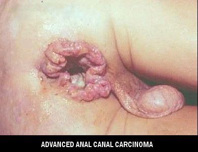 analcancer.jpg