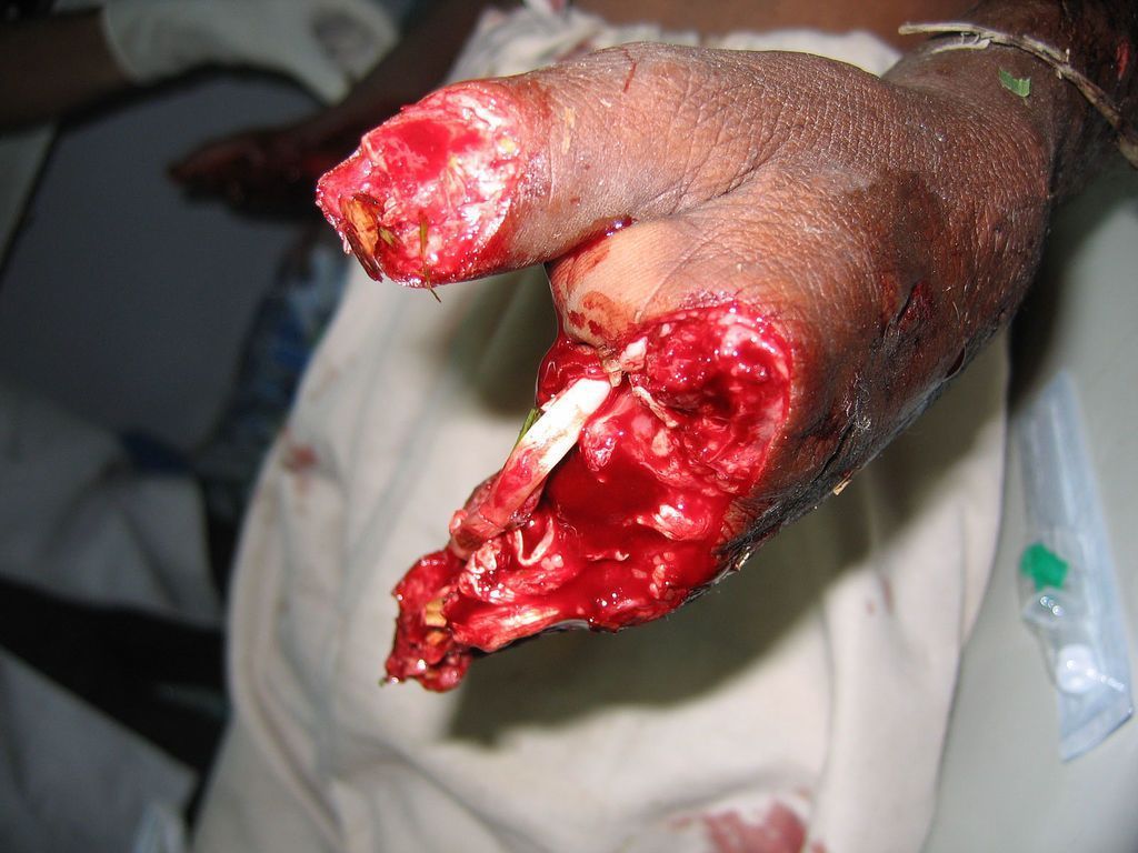 drunk worker hand in machine 1.jpg