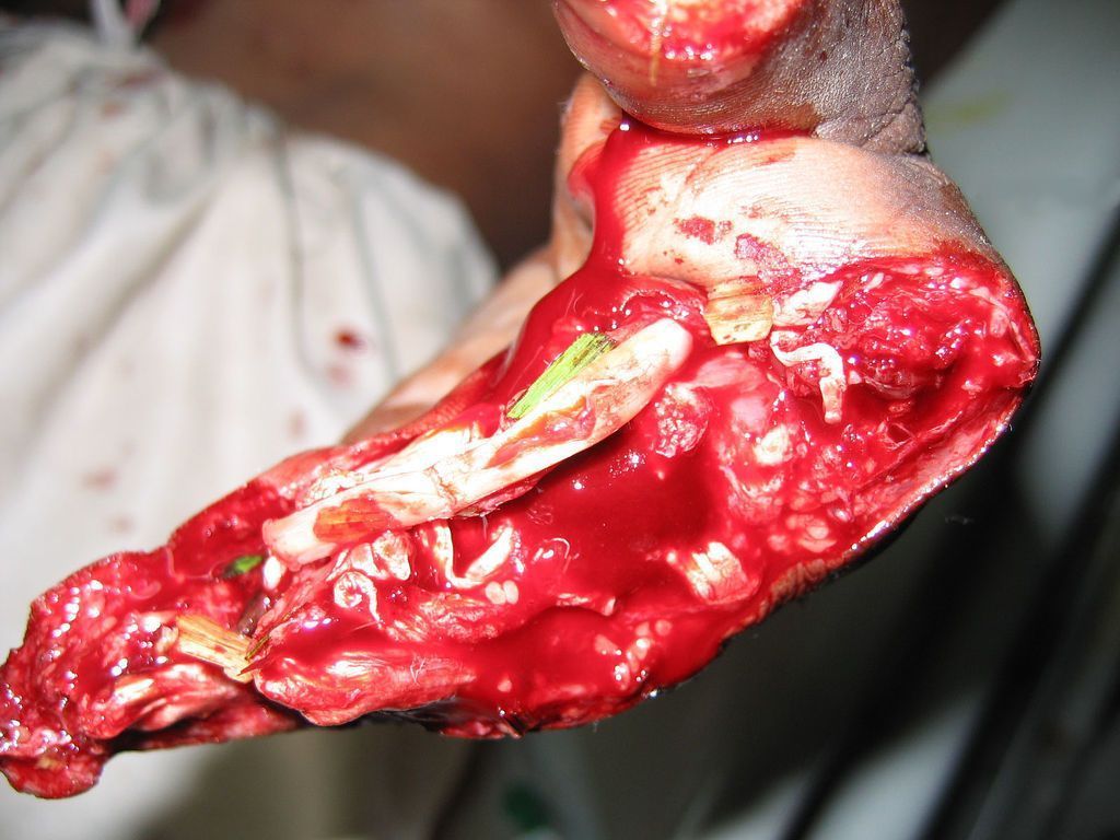 drunk worker hand in machine 3.jpg