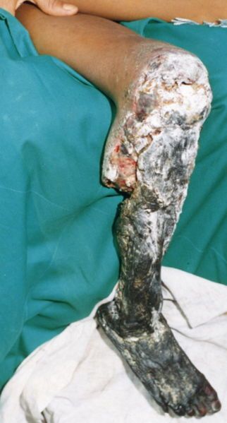 Tissue_necrosis_following_bite_from_Bothrops_asper.jpg
