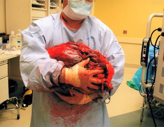 ht_linda_rittenbach_tumor_080716_ssh.jpg