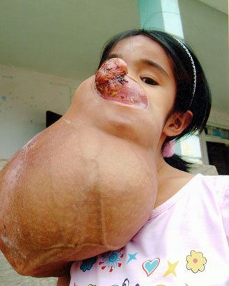 ht_Vietnamese-girl-tumor_080421_ssv.jpg