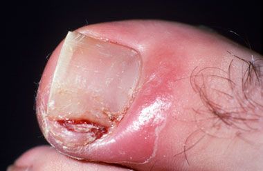 2ndDeg_Infected_Ingrown_Toenail_001.jpg