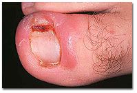 ingrown.jpg