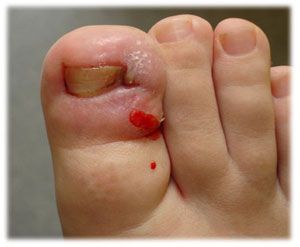 ingrown2.jpg