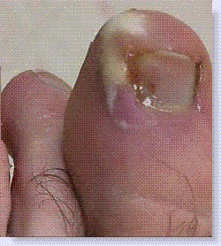 paronychia.gif