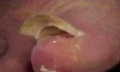 toenail-removal-sm.jpg