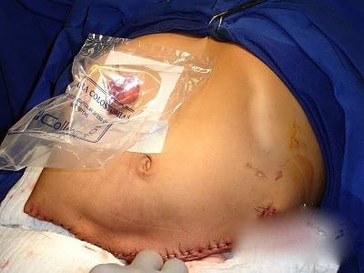 Hemicorporectomy: "Lumbarectomy" Translumbar Amputation - 186711 thumb