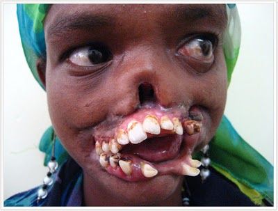 Noma Cases: Cancrum Oris Noma and Gangrenous Stomatitis - noma1