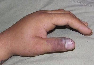 snakebite.jpg