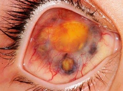 retinoblastoma.jpg
