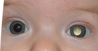 misc-retinoblastoma-0602.jpg