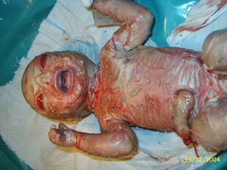 ichthyosis.jpg