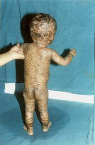 lamellar_ichthyosis_revised_clip_image002.jpg