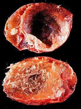DermoidCyst_gross.JPG