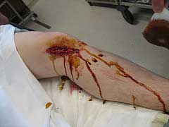 chain-saw-injury.jpg
