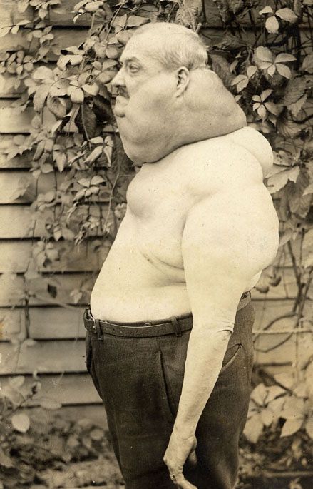 banjo-goiter-3.jpg