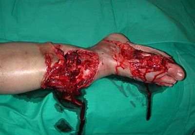 leginjury.jpg