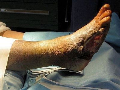 amputation.jpg