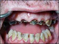 meth_teeth_rotten_1.jpg